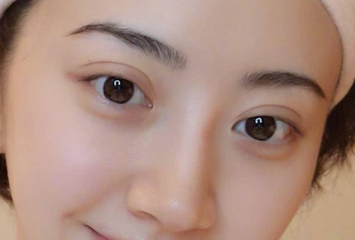 那些適合做雙眼皮手術的人群